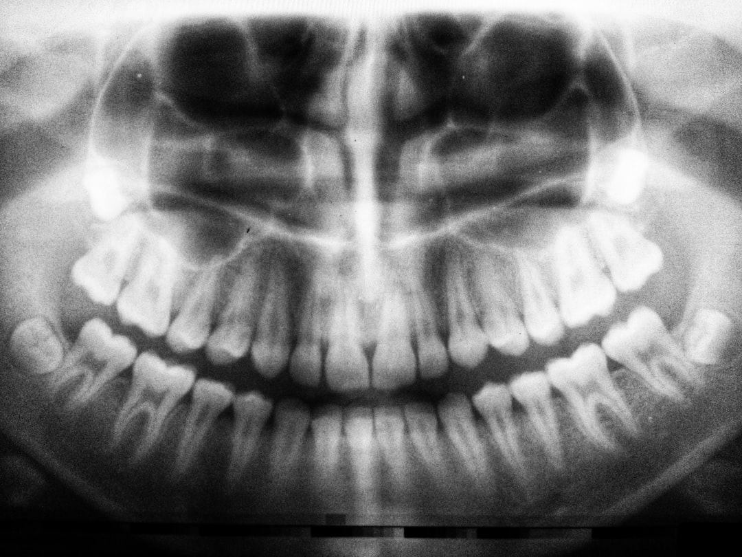 Failed Dental Bone Graft: Healing Pictures